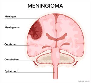 Diagram of a brain with a meningioma tumor on the outside of the cerebrum.