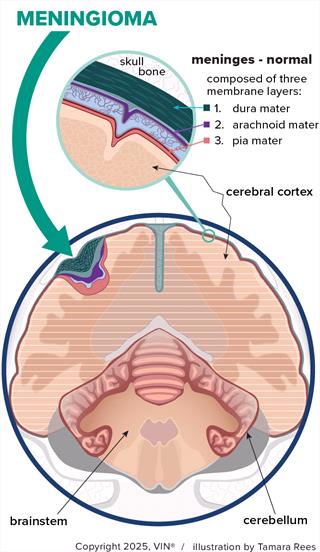 Diagram of a brain with a meningioma tumor on the outside of the cerebrum.