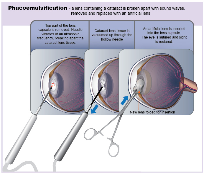 Diagram showing cataract removal surgery.