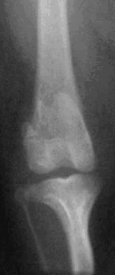Radiograph of luxating patella 