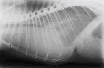 Chest X-ray showing chylothorax
