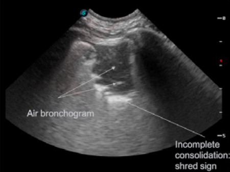 State-of-the-Art Lecture: Advanced Lung Ultrasound: Subpleural ...