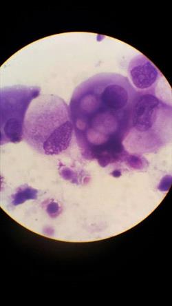 Urine sediment cytology (view through microscope) with cells consistent with transitional cell carcinoma