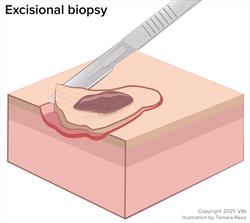 Excisional biopsy technique