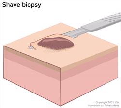 Shave biopsy technique