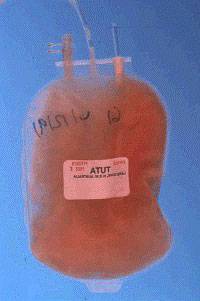 A plasma transfusion bag